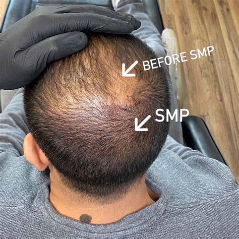 scalp micropigmentation wimbledon|Scalp Micropigmentation Overview: Cost, Recovery, Before & After .